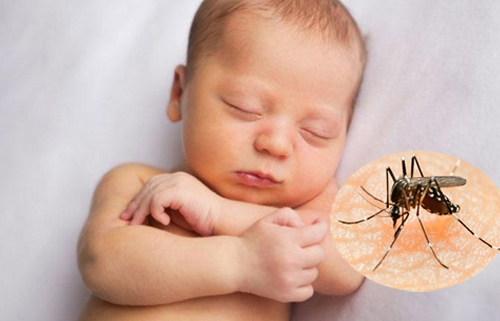 Trẻ sơ sinh nhiễm virus Zika có bị hội chứng đầu nhỏ không?