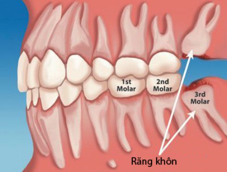 Nhổ răng khôn có nguy hiểm không? bạn nên biết