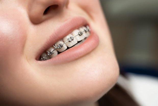Có thể bạn chưa biết về phương pháp niềng răng thời cổ đại 